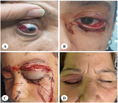 Clinical characteristics and visual outcomes of animal-induced ocular injuries: a prospective multicenter study in Iran